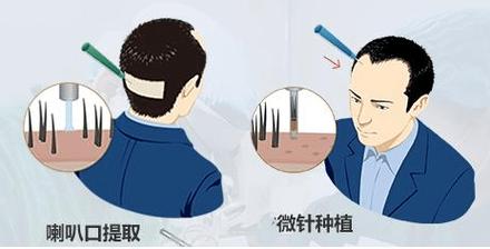 荔湾人民医院整形植发价格怎么样？全新价格详情