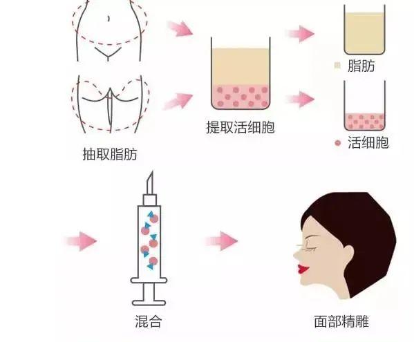 丰太阳穴整形手术价格表一览：了解不同填充方式的费用多少及手术效果