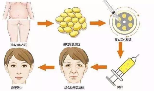 2025年泪沟填充手术价格表：玻尿酸与自体脂肪填充价格对比及科普