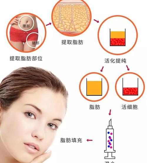 脂肪填充手术费用解析：价格表一览，多少钱快速，价格贵吗？