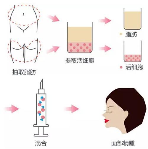 脸部自体脂肪填充价格贵吗？通常会填充哪些部位？