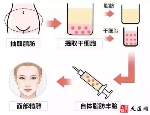 面部脂肪填充多少钱？价格贵吗？