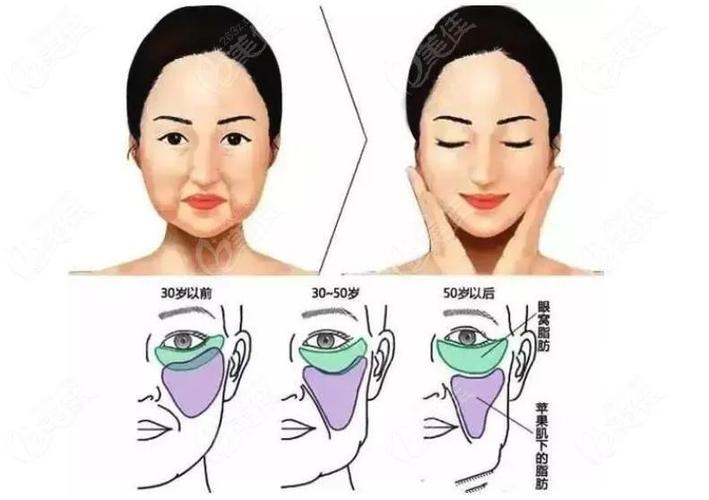 脂肪填充手术价格表：价格表揭秘，1万元是否足够？