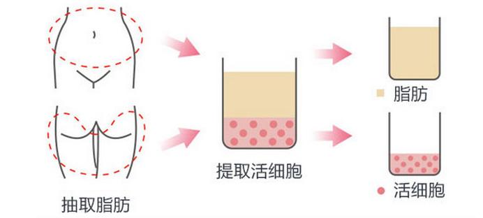 阴道松弛有哪些原因 泉州青阳东方整形医院阴道紧缩术方式是什么