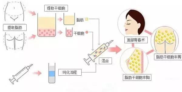 成都自体脂肪填充泪沟多少钱？附成都自体脂肪填充泪沟价目表