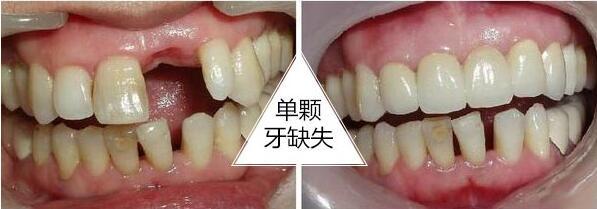广州市水冷激光牙周治疗排行强榜前10今日分享-广州市水冷激光牙周治疗口腔医