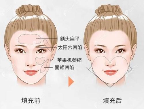 为什么有的人做了自体脂肪丰苹果肌之后不好看