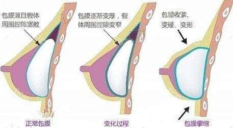 自体脂肪隆下巴手术价格表，价格贵吗？效果持久吗？有哪些潜在危害？