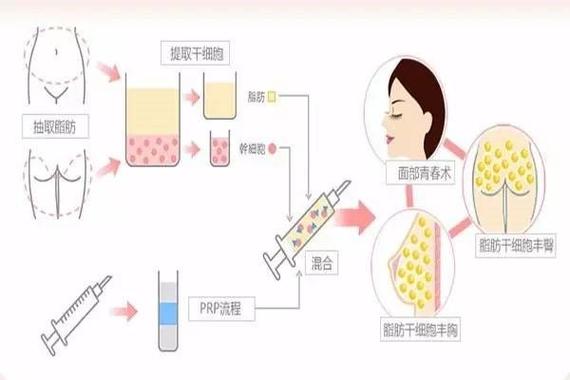 东莞地区丰胸整形手术费用解析：硅胶、假体、自体脂肪等价格一览表