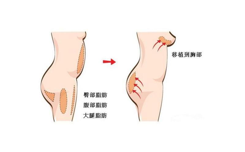 自体脂肪垫下巴的效果能够维持多长时间？