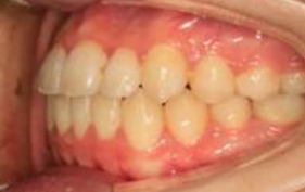 什么样的牙齿需要矫正？你的牙齿是这样吗？