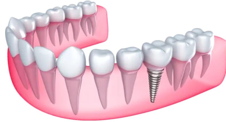 镶牙有几种方式哪个好？镶牙的费用大概多少你了解吗？