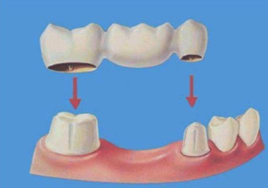 镶牙有几种方式哪个好？镶牙的费用大概多少你了解吗？