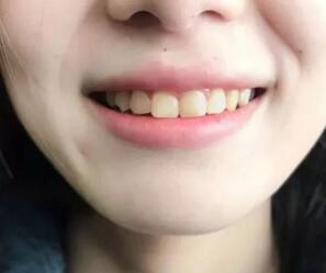 天津红桥口腔医院正规吗，做牙齿美白可以吗？附牙齿美白案例和价格表！