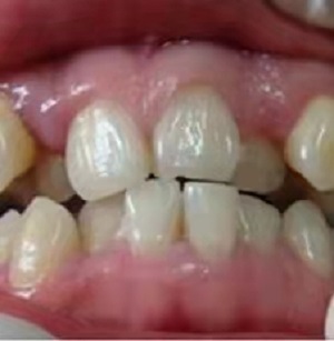 牙齿门牙有点歪需要矫正吗，牙齿纠正前后照片