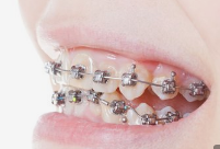 牙齿矫正有什么方法？大家知道如何选择吗？矫正效果如何？