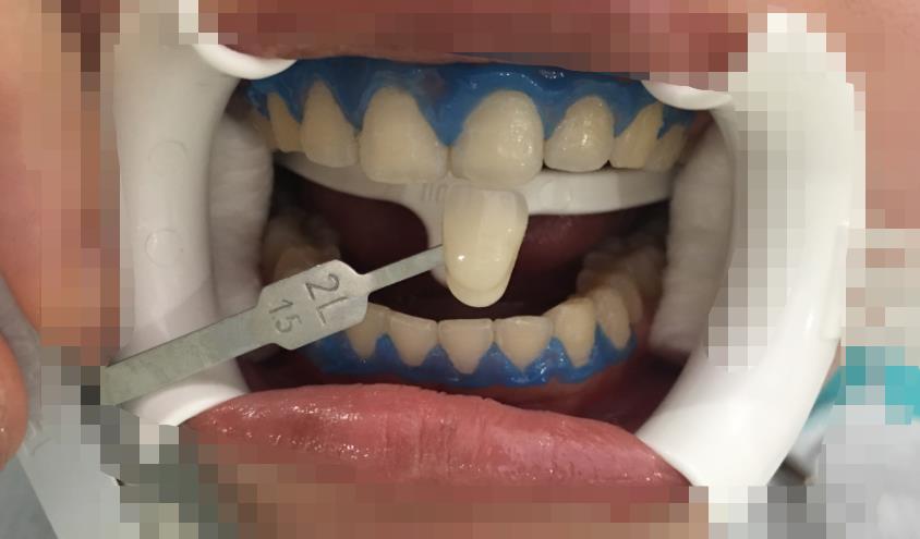 溧水口腔医院能做牙齿美白项目吗？医院介绍附案例和价格表！