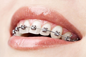 矫正一颗牙齿要多少钱？这篇文章告诉你牙齿纠正的价格