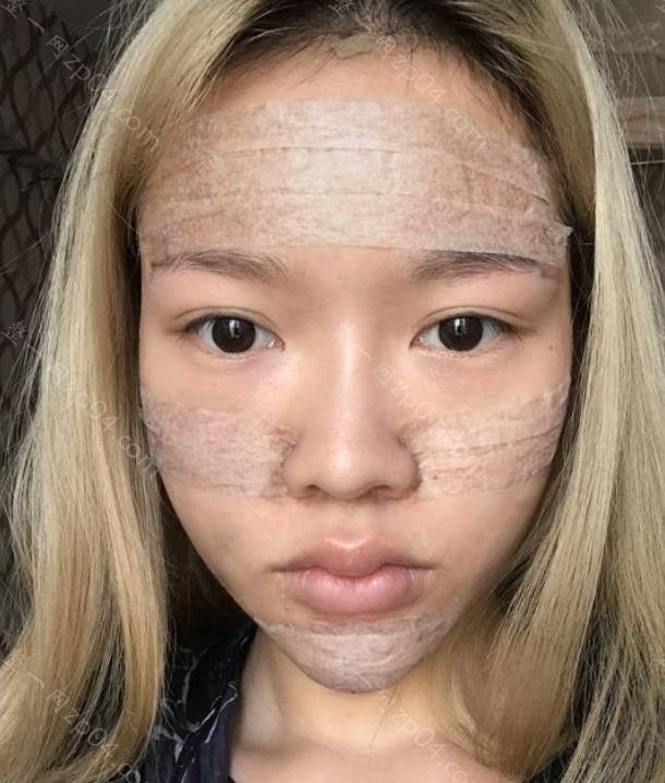 北京驭美客怎么样？做面部填充的技术如何呢？附上案例图