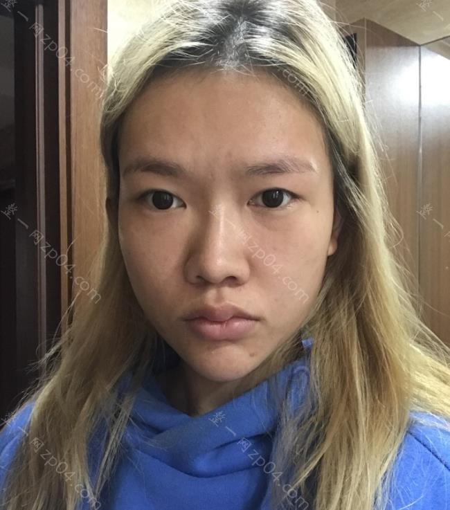 北京驭美客怎么样？做面部填充的技术如何呢？附上案例图