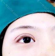 开双眼皮多少？价格区间一般在多少？