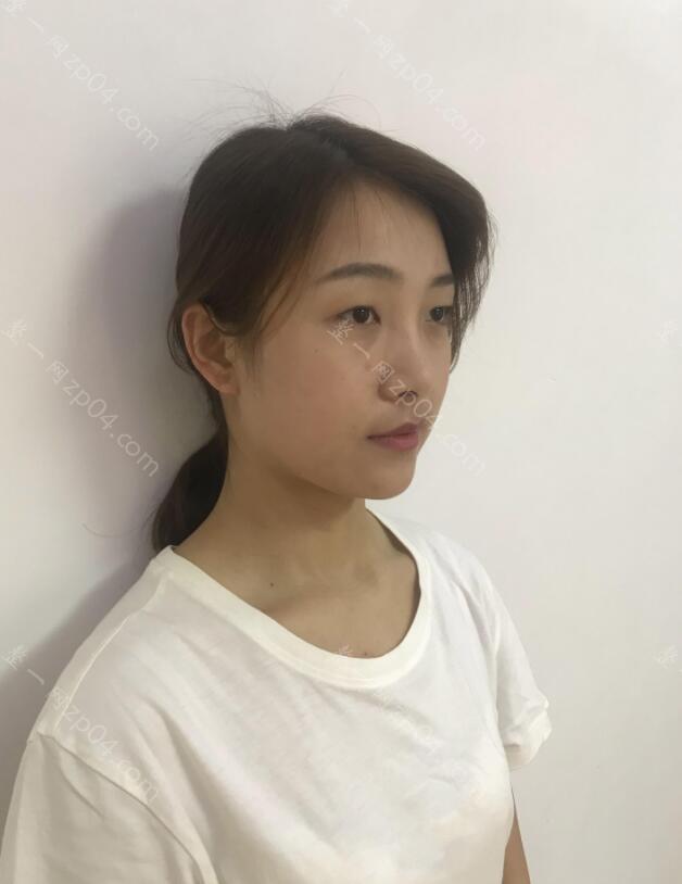 眼睛不好看该怎么办？做一个双眼皮整形试试吧！