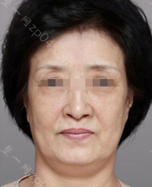 面部注射玻尿酸失败是什么原因？有什么作用呢
