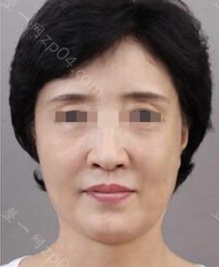 玻尿酸除皱好不好？面部注射费用一般是多少？