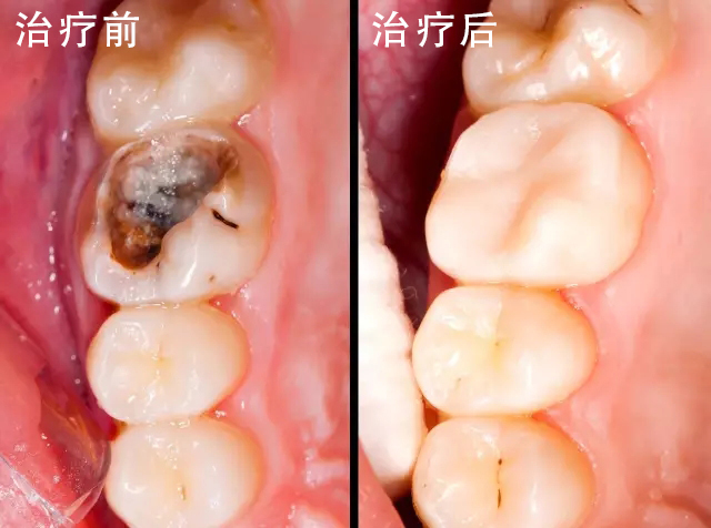 缺牙后的5种后果及常见3种修复方案