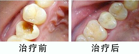 新化学物100％防蛀牙再不用看牙医