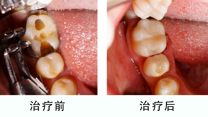 补牙，有效对抗龋齿