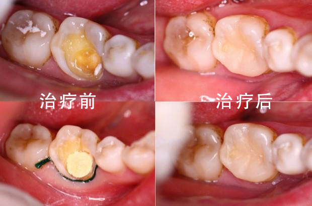 青霉素过敏的患者使用利多卡因是否会过敏