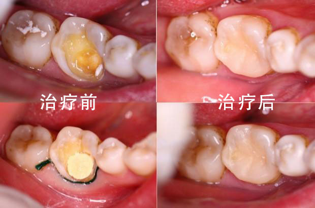 小孩有蛀牙怎么办