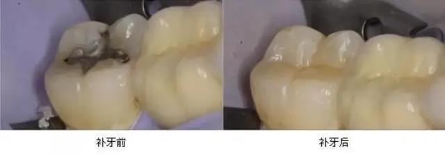 补牙后要注意哪些事情