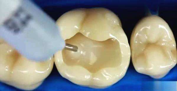 全口义齿修复后应如何使用、保养