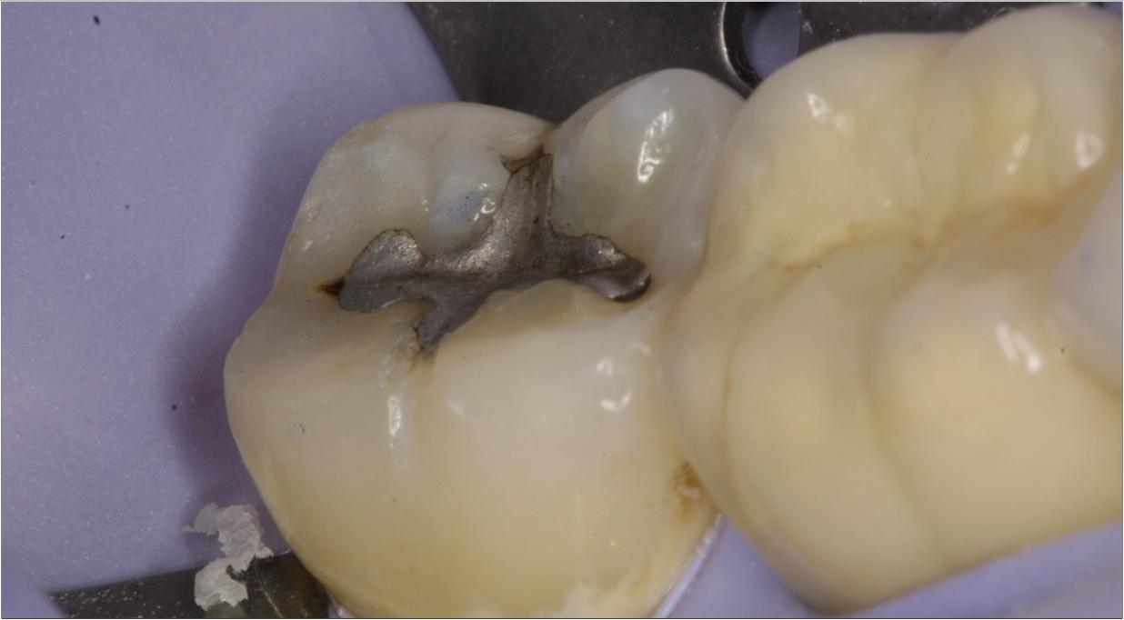 牙齿种植可能会发生的并发症
