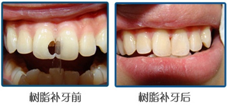 补牙疼不疼 术后要注意什么