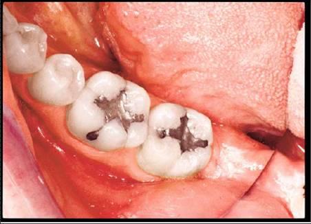 树脂补牙的优点和缺点