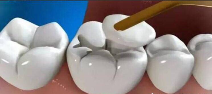 拔牙后如何快速止血