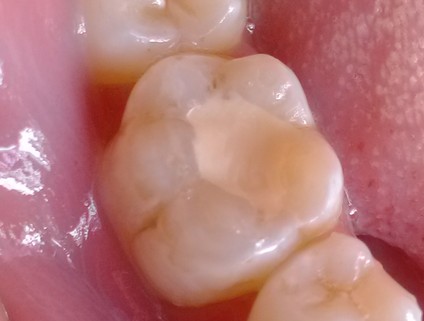 补牙后补牙材料掉了是什么原因