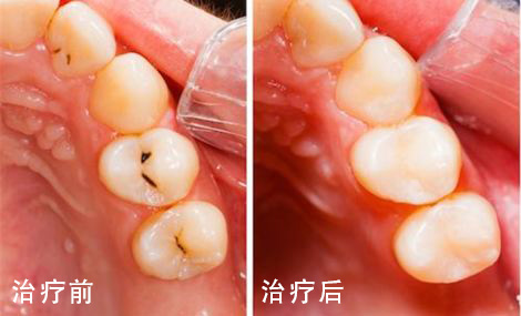 我的牙缝太大，可以补吗？