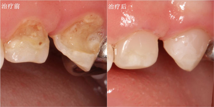 补牙的各种材料的优缺点