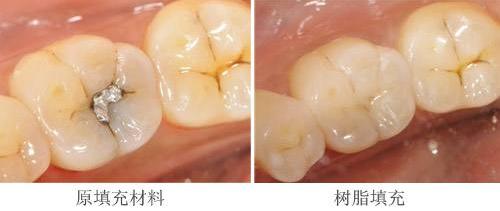 树脂补牙的优点和缺点是什么