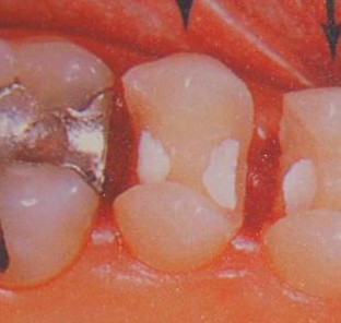 怎么做可以预防牙齿坏死的发生呢？