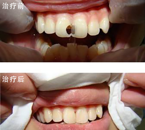 10种牙齿需要被拔掉