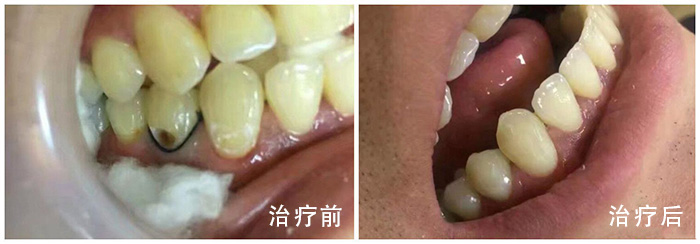 镶牙后如何保护牙龈健康？