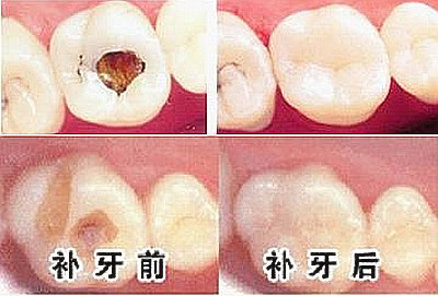 牙体缺损治疗原则