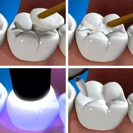 补牙树脂材料有哪些优势