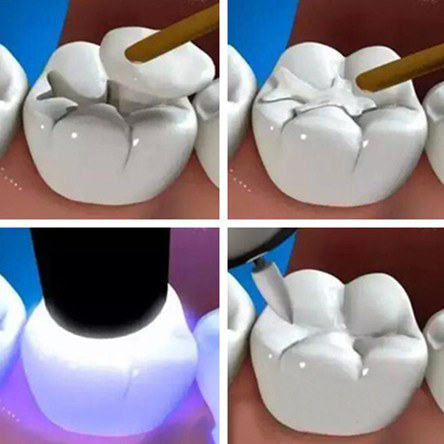 补牙材料脱落的6个原因