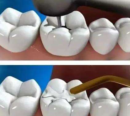 解析蛀牙形成的原因